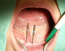 Mini Implantaten verankert abnehmbaren voller unteren Prothese