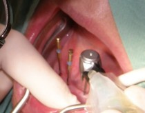 Mini Implantaten verankert abnehmbaren voller unteren Prothese